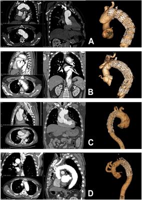 Surgical Repair of Two Kinds of Type A Aortic Dissection After Thoracic Endovascular Aortic Repair